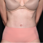 Tummy Tuck Before & After Patient #34348